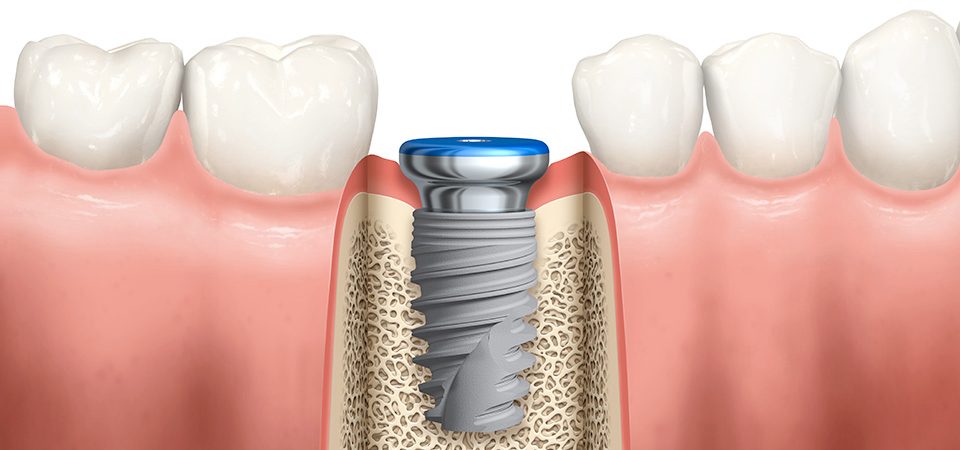 implantinner