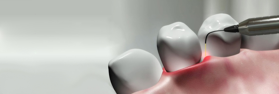 laser dental